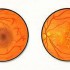 Treatment for Macular Degeneration