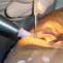 Cataract Surgery