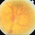 Epidemiology and Treatment of Ischemic Optic Neuropathy