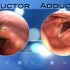 Spasmodic Dysphonia