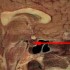 Gamma knife surgery for pituitary adenoma