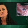 Olfactory sense reduced in lupus patients