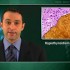 Hypothyroidism linked to liver cancer in women