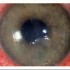 Corneal infections