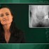 Fixation of cementless acetabular implants stable for at least 20 years
