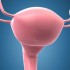 Endometrial ablation has a high failure rate