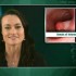 10-year follow-up may be reasonable after 2 negative colonoscopies