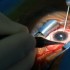 Presbyopia correcting artificial lenses