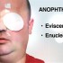 Losing an eye – how to treat