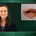 Erlotinib may improve rates of surgically curable bladder cancer