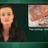Liquid-based cytology not better than Pap test at detecting cervical neoplasia