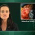 NSAIDs linked to lower mortality after colorectal cancer diagnosis