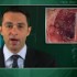 Course of pediatric Crohn’s less complicated with early onset than with later onset