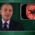 Surveillance guidelines may miss early cancer in IBD patients