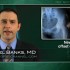 Lasofoxifene cuts fractures, breast CA, ischemic events — but still has a down side