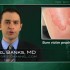 Prophylactic antibiotics may cut mortality in burn patients
