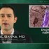 Longer follow-up confirms advantage of sirolimus-eluting vs bare metal stents