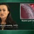 Drug-eluting stents better than bare metal for saphenous vein graft interventions