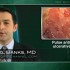 Antibiotic combo promotes remission of active ulcerative colitis