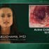 Infliximab plus azathioprine effective for stubborn Crohn’s disease