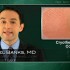 Cryotherapy works best for common warts