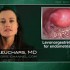 Levonorgestrel IUD may be better than oral progestogens for endometrial hyperplasia