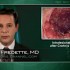 Intralesional steroids beneficial after Crohn’s stricture dilation in children