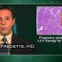 Pregnancy outcomes normal after I-131 therapy for thyroid cancer