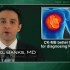 Intracoronary adenosine during PCI improves results in STEMI patients