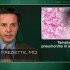 Temsirolimus-related pneumonitis common in advanced renal cell carcinoma