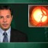 Canaloplasty an option in the management of open-angle glaucoma