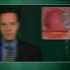 Mesalamine once-daily OK for ulcerative colitis maintenance therapy
