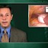 Porcelain gallbladder only weakly associated with gallbladder cancer