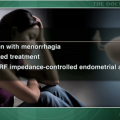 Bipolar RF endometrial ablation beats hydrothermablation for menorrhagia