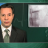 Sirolimus-eluting stent a good option for BMS and DES in-stent restenosis