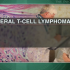 Romidepsin effective for refractory peripheral T-cell lymphoma