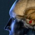Cabergoline combined with low-dose pegvisomant effective in acromegaly