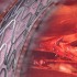 Very late stent thrombosis less with newer devices