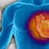 Pre-surgery statins cut risk of cardiac events, but questions remain
