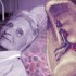 Ruxolitinib effective for myelofibrosis