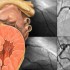 Timing of angiography/revascularization for non-STE ACS does not affect outcomes
