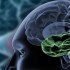 Early surgery beneficial in intractable temporal lobe epilepsy
