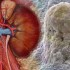 Autologous stem cells prevent acute rejection in renal transplantation