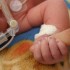 Less invasive protocol helps preemies breathe easier in limited resource settings