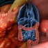 No benefit adding cetuximab to chemo after colon cancer resection