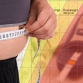 Sleeve gastrectomy better than medical therapy for obesity-related diabetes