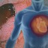 Risk/benefit of anticoagulation generally neutral in AF with GI ulcer