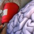 Lower BP guards against brain bleeds related to antithrombotic therapy