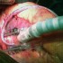 Outcomes similar with on-pump or off-pump CABG in elderly patients