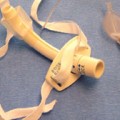 Early tracheostomy when needed after cardiac surgery has benefits
